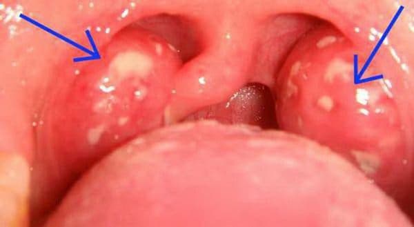 Bệnh ung thư amidan sống được bao lâu?