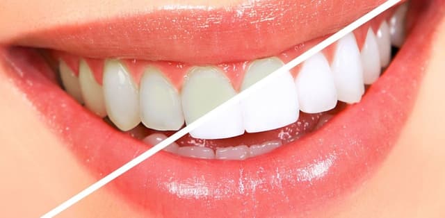 Bảng giá tẩy trắng răng hiện nay có cao không?