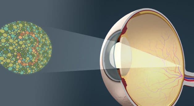 bệnh hắc võng mạc