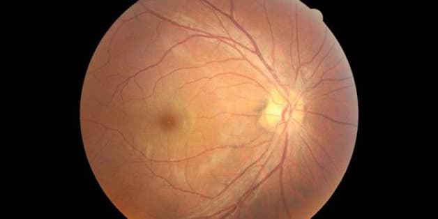 Bệnh hắc võng mạc