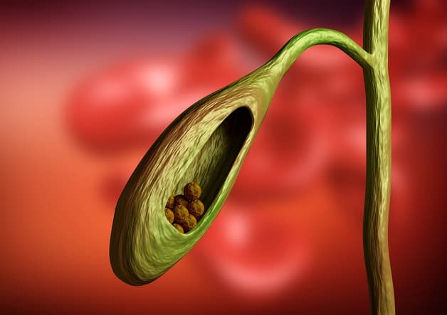 Bệnh sỏi túi mật là gì?