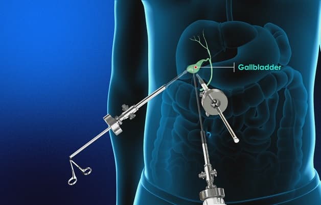 Điều trị bệnh sỏi túi mật