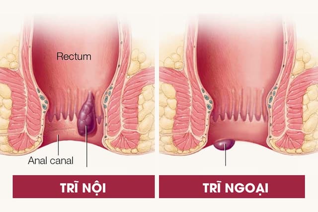 Bệnh trĩ khám ở đâu &#8211; Góc giải đáp