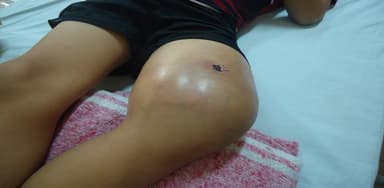 Dấu hiệu bệnh ung thư xương phổ biến nhất