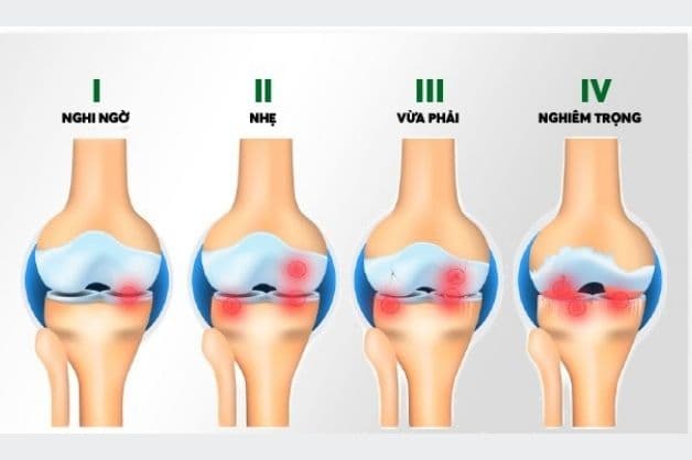 thoái hóa khớp gối bệnh học trải qua 4 giai đoạn tiến triển