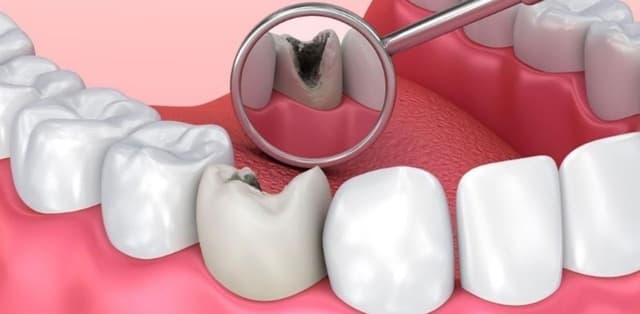 Bỏ túi cách điều trị sâu răng tại nhà hiệu quả