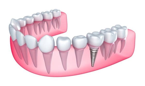 Phương pháp cấy ghép Implant được áp dụng trong phục hình răng hàm bị mất