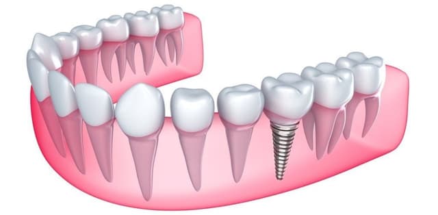 Tìm hiểu về chi phí trồng răng hàm tại nha khoa hiện nay