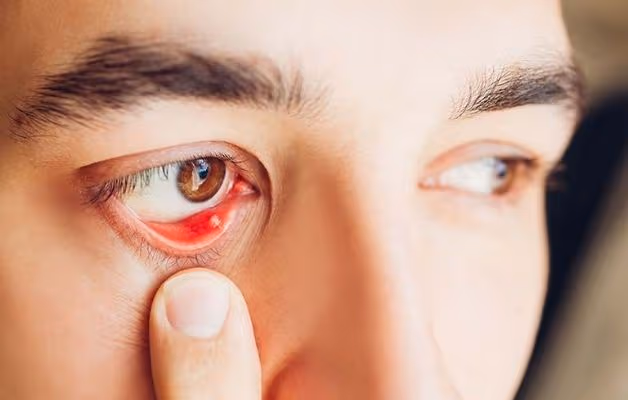 Chữa chắp mắt trong