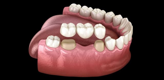 Giá tiền trồng răng sứ tại nha khoa cao bao nhiêu?