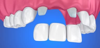 Giá trồng răng cửa hiện nay tại nha khoa