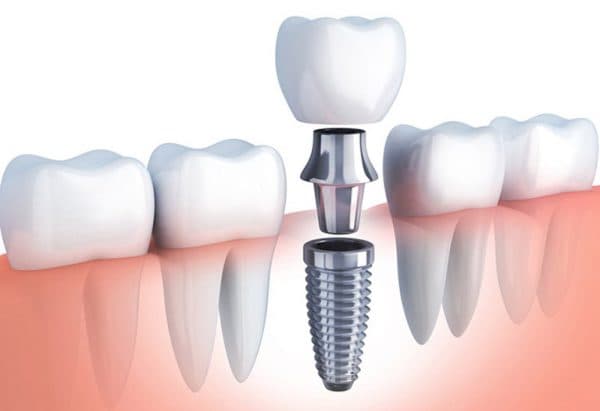 Giá trồng Implant Hàn Quốc được đánh giá là vừa tầm, dao động từ 15-20 triệu đồng/răng