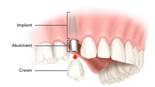 Implant có cấu tạo bao gồm trụ titanium như một chiếc chân răng thật với khớp nối abutment và mão răng sứ