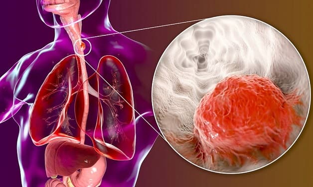 Thực hiện hóa trị ung thư thực quản