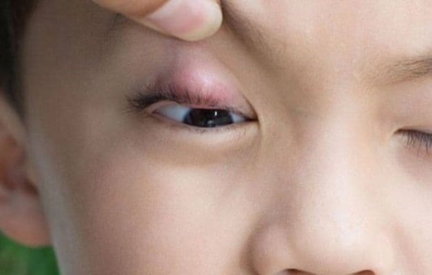 lẹo mắt bị chai