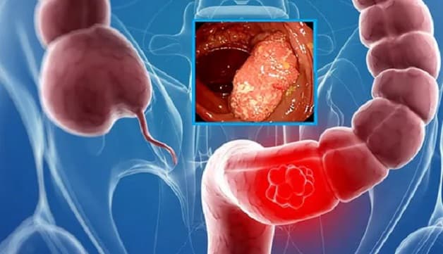 phẫu thuật ung thư đại trực tràng