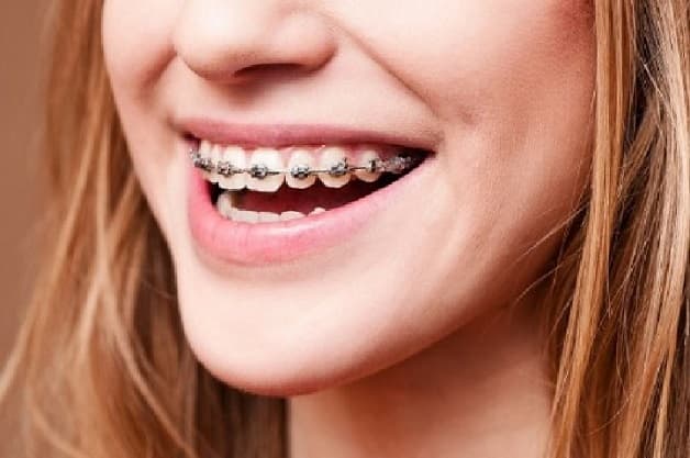 Thời gian niềng hàm trên dao động trong khoảng 8 tháng đến 2 năm tùy thuộc vào từng trường hợpThời gian niềng hàm trên dao động trong khoảng 8 tháng đến 2 năm tùy thuộc vào từng trường hợpThời gian niềng hàm trên dao động trong khoảng 8 tháng đến 2 năm tùy thuộc vào từng trường hợp