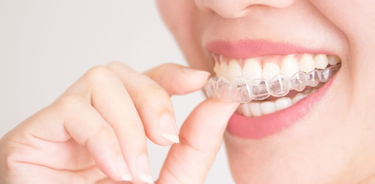 Niềng răng hàm trên giá bao nhiêu tiền hiện nay?