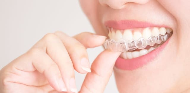 Niềng răng hàm trên giá bao nhiêu tiền hiện nay?