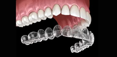 Niềng răng hô hàm trên giá bao nhiêu tại nha khoa?