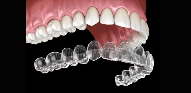 Niềng răng hô hàm trên giá bao nhiêu tại nha khoa?