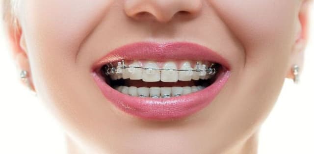 Niềng răng thưa giá bao nhiêu, có cao không?