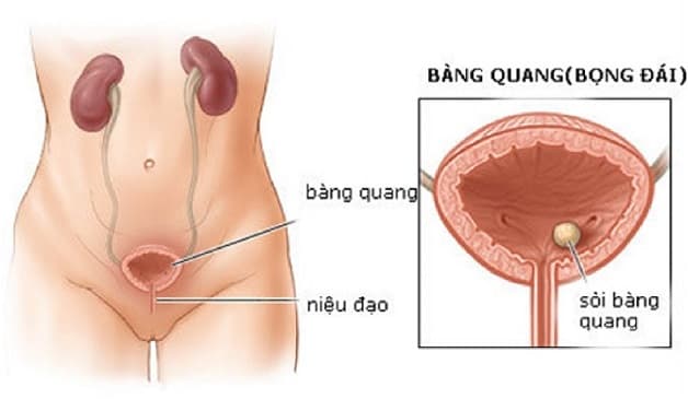 Dấu hiệu sỏi bàng quang