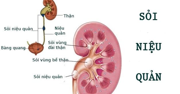 biến chứng của sỏi niệu quản ⅓ trên