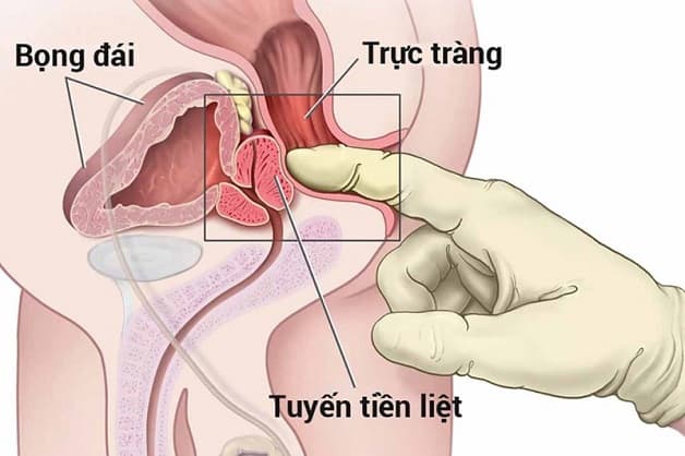 Ung thư tuyến tiền liệt 