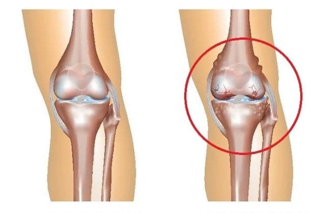 Thoái hóa khớp gối m17 xảy ra khi lớp sụn bị bào mòn, tổn thương nặng nề