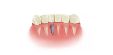 Chuyên gia giải đáp: Trồng 1 cái răng bao nhiêu tiền?