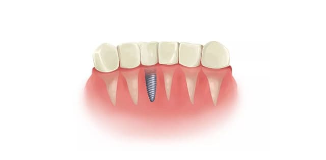 Chuyên gia giải đáp: Trồng 1 cái răng bao nhiêu tiền?