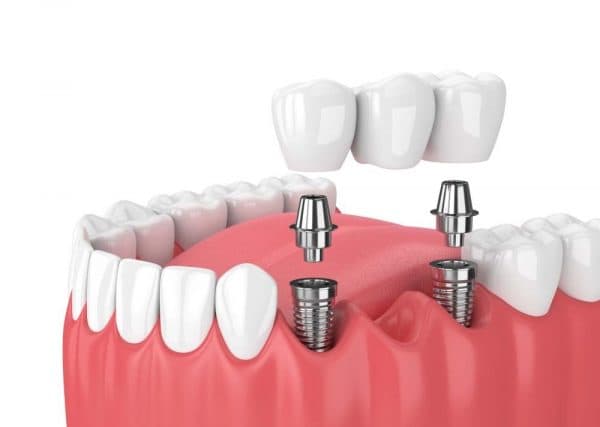 Cấy ghép Implant là giải pháp trồng răng phục hình hiện đại có thể khắc phục mọi khiếm khuyết của việc mất răng gây ra