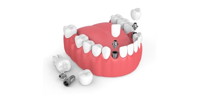 Giải đáp: Trồng răng sứ bao nhiêu tiền tại nha khoa?