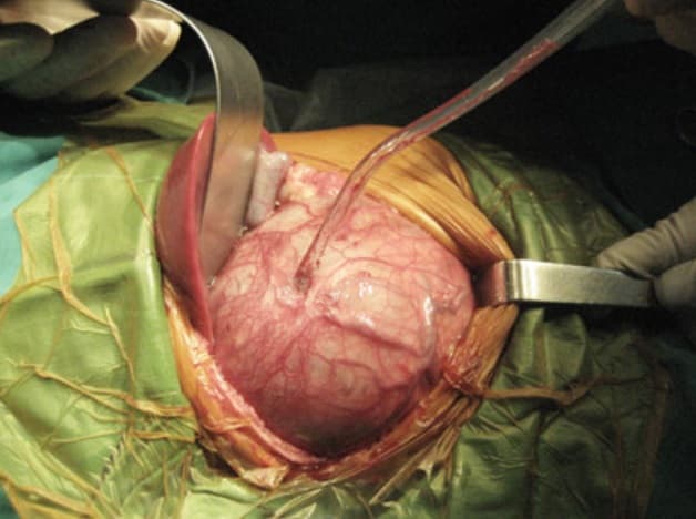 dấu hiệu ung thư nguyên bào thần kinh là gì