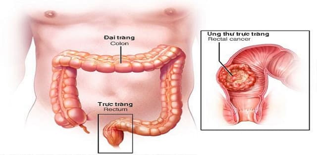 Phẫu thuật ung thư đại trực tràng trong điều trị khi nào? 