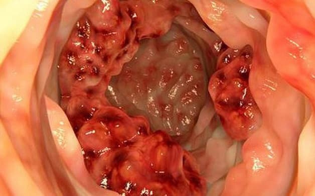 phẫu thuật nội soi ung thư đại tràng