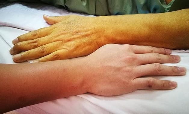 dấu hiệu bệnh ung thư mật