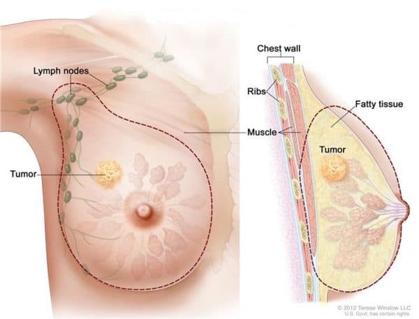 Ung thư vú có chữa được không và điều trị bằng cách nào