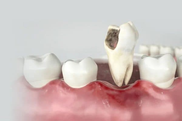 Tình trạng viêm nếu không được điều trị kịp thời và đúng cách sẽ gây ra những biến chứng nguy hiểm như mất răng