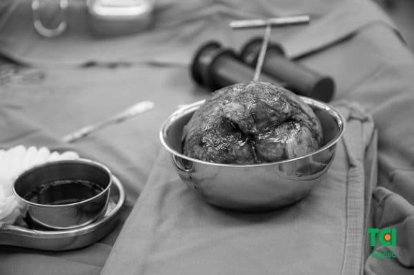 phẫu thuật bóc tách khối u xơ tử cung