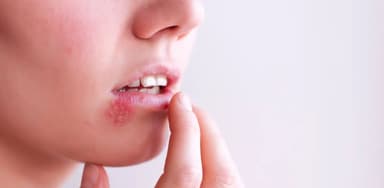Những điều cần lưu ý về bệnh Herpes ở môi