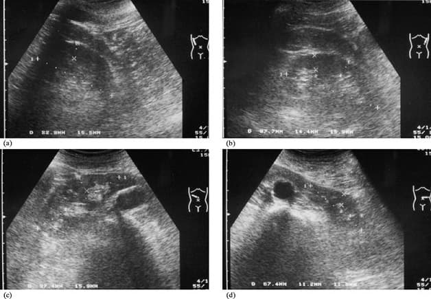 Siêu âm có thể giúp phát hiện sỏi 