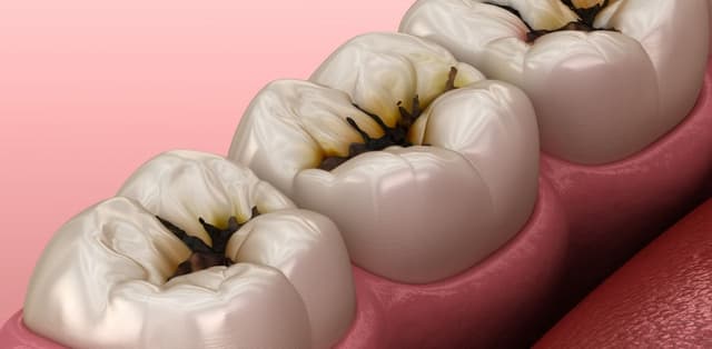 Giải đáp: Bị sâu răng có tẩy trắng được không?