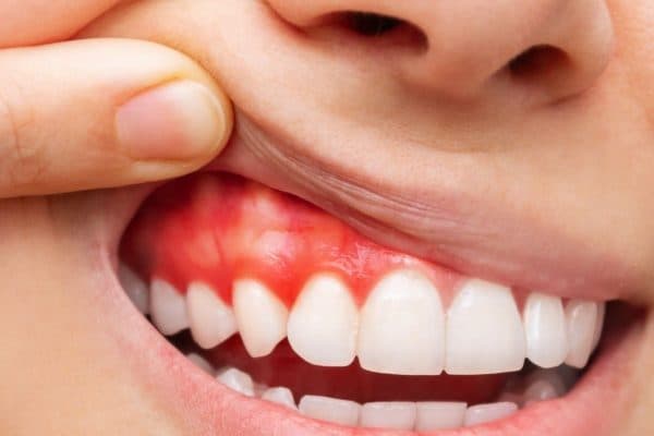 Biểu hiện viêm quanh cuống răng cấp tính là sốt cao trên 38 độ, sưng nề nướu, đau nhức, chảy máu chân răng...