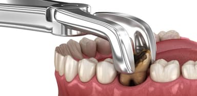 Cách chăm sóc răng mới nhổ để nhanh lành vết thương