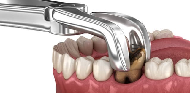 Cách chăm sóc răng mới nhổ để nhanh lành vết thương