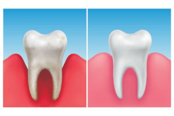 Viêm chân răng là bệnh lý tổn thương các tổ chức quanh răng và chân răng