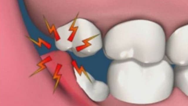 Tìm hiểu các cách khắc phục sâu răng 