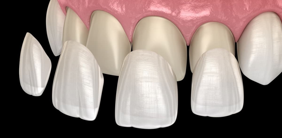 Tìm hiểu ngay, dán sứ sứ veneer là gì?